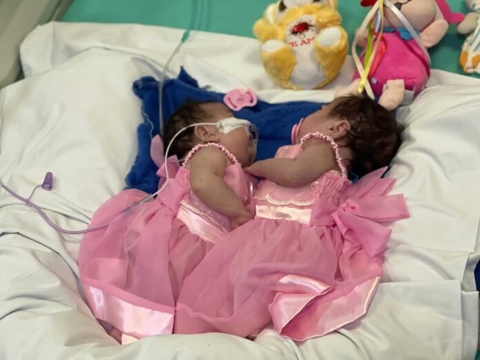 As gêmeas siamesas Yasmin e Eliza, naturais do Amazonas, receberam alta da UTI após passarem por uma complexa cirurgia de separação.