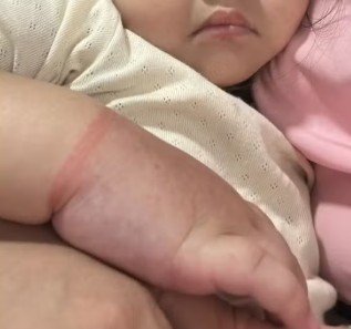 Criança de 2 anos quase perdeu o braço em Manaus após elástico de cabelo interromper a circulação.